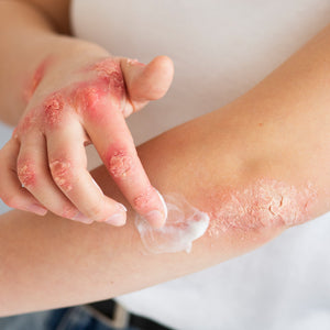 7 Psoriasis Skin Care Tips!