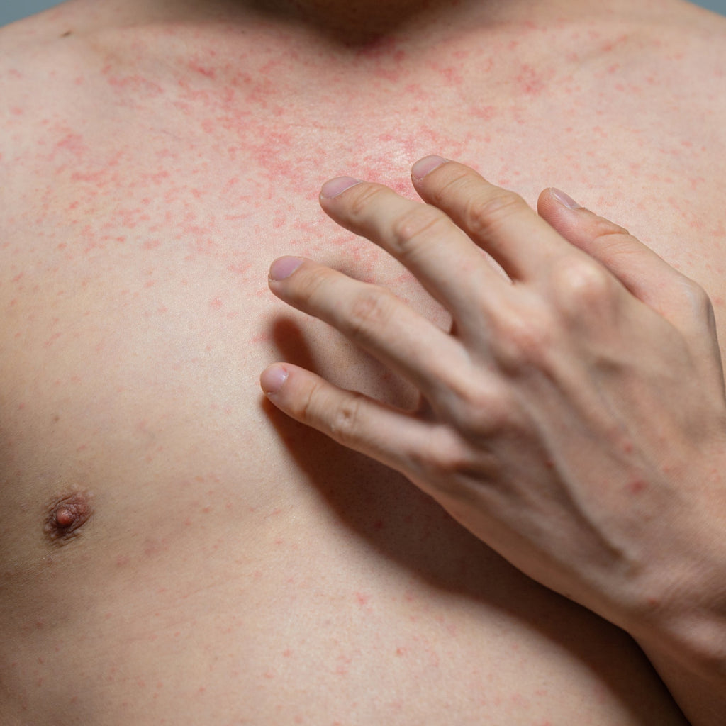 What is psoriasis?